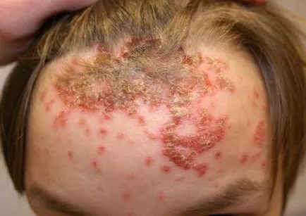 Streptoderma pe cap (păr)