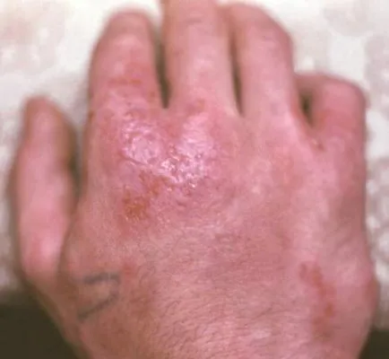 Vannak olyan hagyományos kezelési módszerek Az allergiás dermatitis