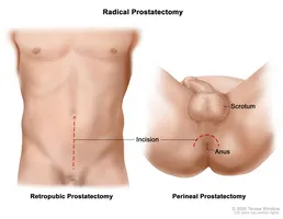 De ce ar trebui să folosesc sunătoare cu prostatita