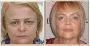 Face Lift Съвети - масаж - упражнения