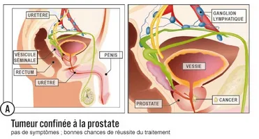 De ce ar trebui să folosesc sunătoare cu prostatita