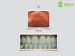 Transgingival имплантиране, което е, професионалистите, на цената на един транс-имплантиране