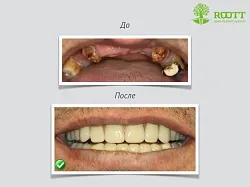 Transgingival имплантиране, което е, професионалистите, на цената на един транс-имплантиране