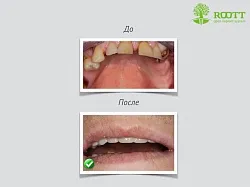 Transzgingivális implantáció, azaz a profik, az ár egy transz-beültetés