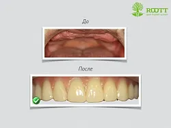 Transzgingivális implantáció, azaz a profik, az ár egy transz-beültetés