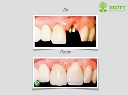 Transzgingivális implantáció, azaz a profik, az ár egy transz-beültetés