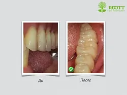 Transzgingivális implantáció, azaz a profik, az ár egy transz-beültetés