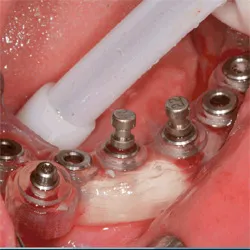 ratele de implantare transgingivală in Bucuresti