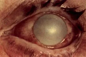 лечение на очите травма у дома народни средства
