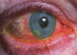 Eye tratament prejudiciu la căi de atac acasă populare
