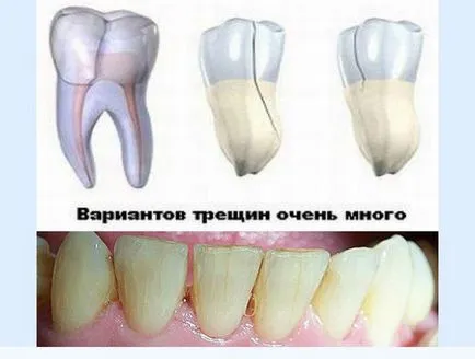 Cracked dinte vertical, ce să facă pentru a găsi metode de eliminare a fisurilor dentare ale articolelor noastre!