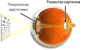 Лазерно отстраняване на катаракта - модерна и ефективна работа без последствия