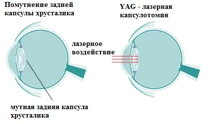 Chirurgia cataractei - ochii Microchirurgie Fedorov