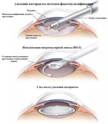 Chirurgia cataractei - ochii Microchirurgie Fedorov