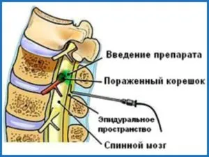Инжекциите с сортове гръбначния херния