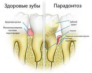 Injecțiile în gingiile cu parodontită de întărire