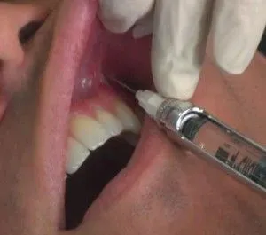 Az injekciók az íny periodontitissel erősítése
