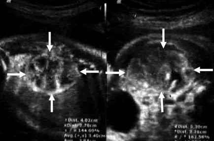 Ultrahang diagnosztika mezoblasticheskoy nephroma a magzat iii trimeszterben - azaz Yudina