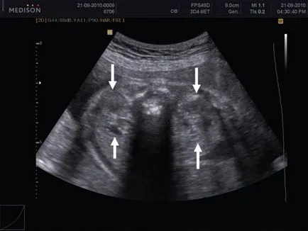 Ultrahang diagnosztika mezoblasticheskoy nephroma a magzat iii trimeszterben - azaz Yudina