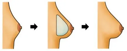 Увеличаването на бюста съвременни методи на инсталация имплант, на портала