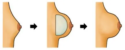 Увеличаването на бюста съвременни методи на инсталация имплант, на портала