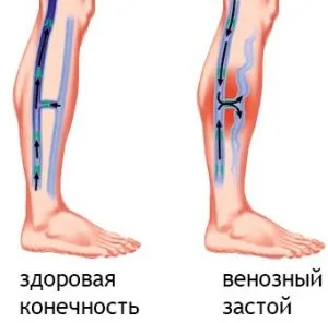 Венозна стаза в краката, главата, таза, бял дроб лечението на