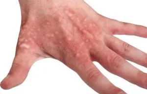 Tipuri de tulburări de pigmentare a pielii și posibile cauze