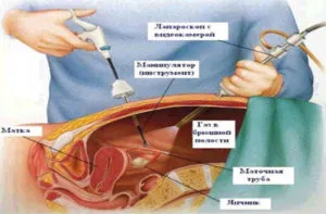 Recuperarea dintr-o dieta de sarcina extrauterina, contraceptive orale, fizioterapie