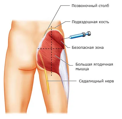 Intramuscularis injekció formájában a fenék tanulni kell tennie magát