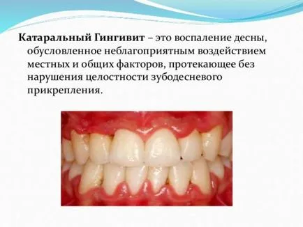 inflamarea gingiilor - ce să facă acasă, se caută răspunsul aici!