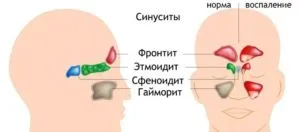 Polisinusit какво е, симптоми и лечение