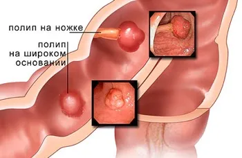 Полип симптоми, лечение, какво да правят в жлъчния мехур