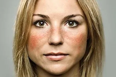 Зачервяване на лицето предизвиква козметичен дефект