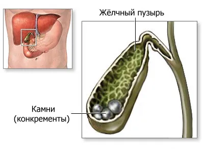 Полип симптоми, лечение, какво да правят в жлъчния мехур