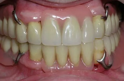 Показания за частични препоръки за зъбни протези