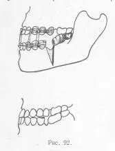 Tratamentul chirurgical al muscatura deschise, stomatologie protetice