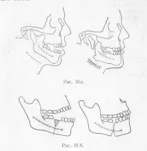 Tratamentul chirurgical al muscatura deschise, stomatologie protetice