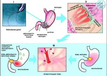 simptome gastrita cronica, semne, cauze, cum de a vindeca boala - tratamentul gastritei