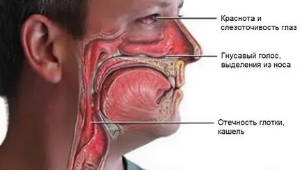 Hátsó rhinitis gyermekek és felnőttek, a tünetek és a kezelés, Komarovsky