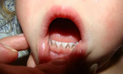 Boala parodontală la copii