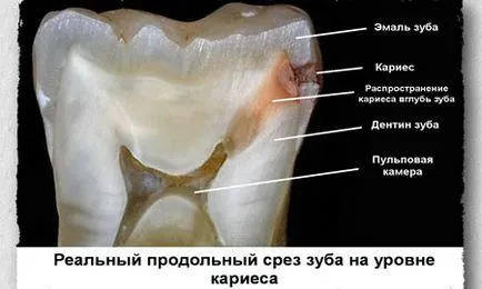 Пародонтоза при деца