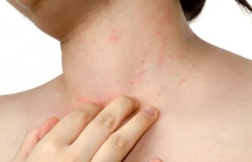 viszkető bőr allergiás okok kezelésére, megelőzésére