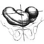 A oldalirányú helyzete a magzat - okai, tünetei, diagnózisa és kezelése