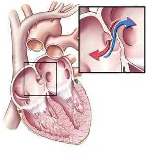 Heart дефект при новородени причинява, видове, симптоми