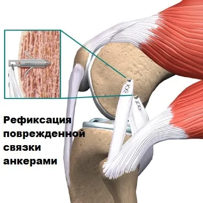 Увреждане на обезпечение сухожилие на коляното