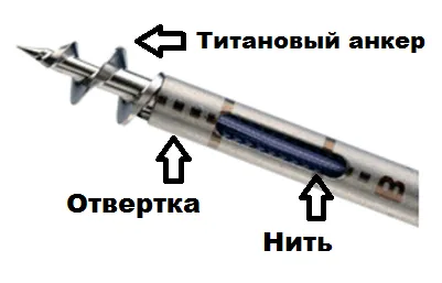 Kár, hogy a supraspinatus ín