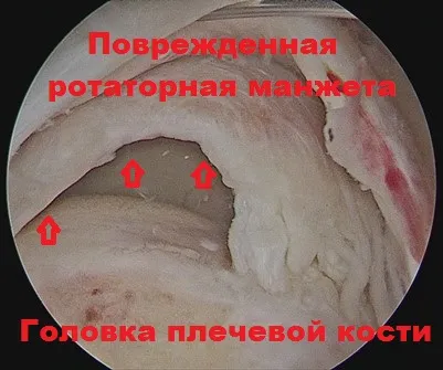 Deteriorarea tendonului supraspinatus