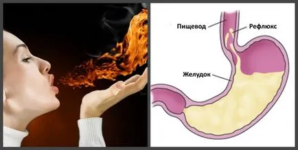 Повърхностно езофагит причини, симптоми, лечение