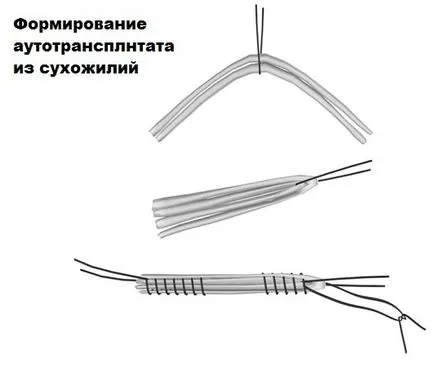 Увреждане на обезпечение сухожилие на коляното