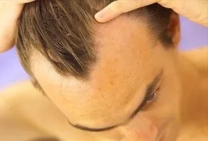 Okai és következményei részleges hajhullás a férfiak reverzibilis alopecia